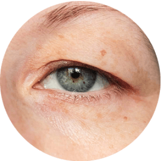 Droopy Eyelids