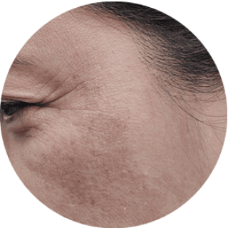 Dull Complexion