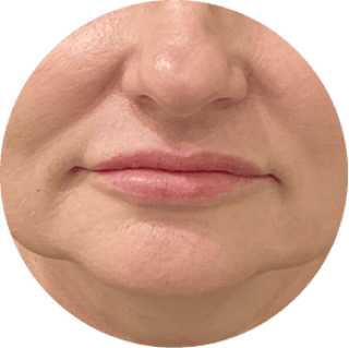 Sagging Jawline