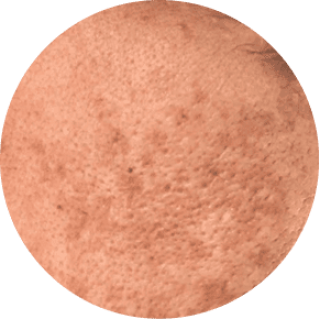 Sun Damage